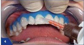 Διαδικασία λεύκανσης δοντιών στο ιατρείο