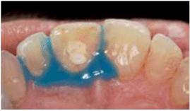 Διαδικασία εσωτερικής λεύκανσης ενδοδοντικά θεραπευμένου δοντιού